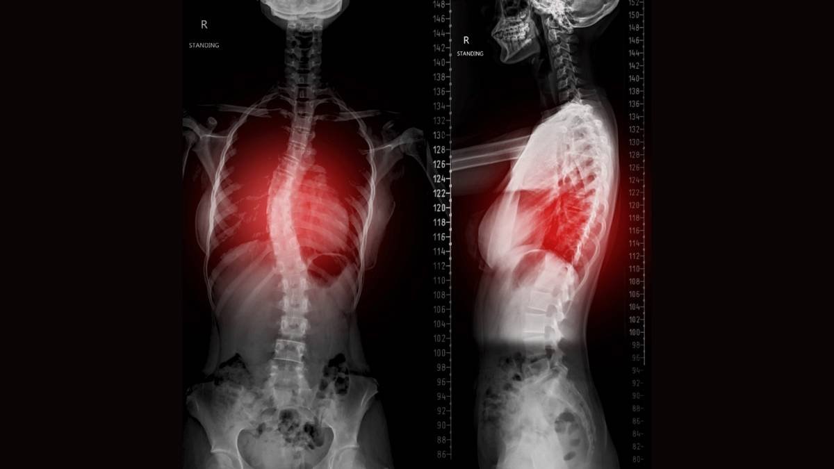 Tratamento da Escoliose: Método Schroth em Foz do Iguaçu-PR 1 Imagem mostrando o raio x de uma escoliose para Método Schroth em Foz do Iguaçu-PR