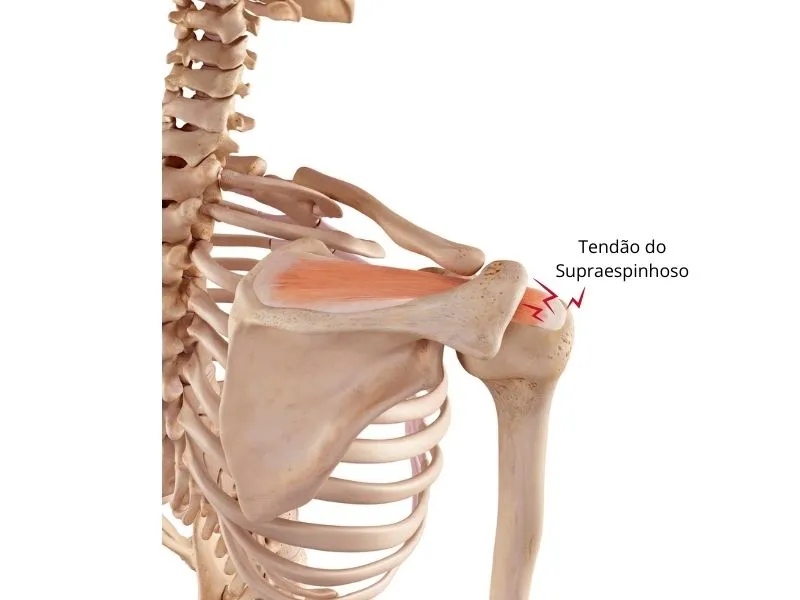 Imagem de anatomia mostrando a tendinite do Supraespinhoso