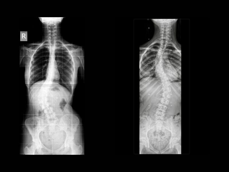 imagem mostrando uma radiografia de uma escoliose idiopática não tratada