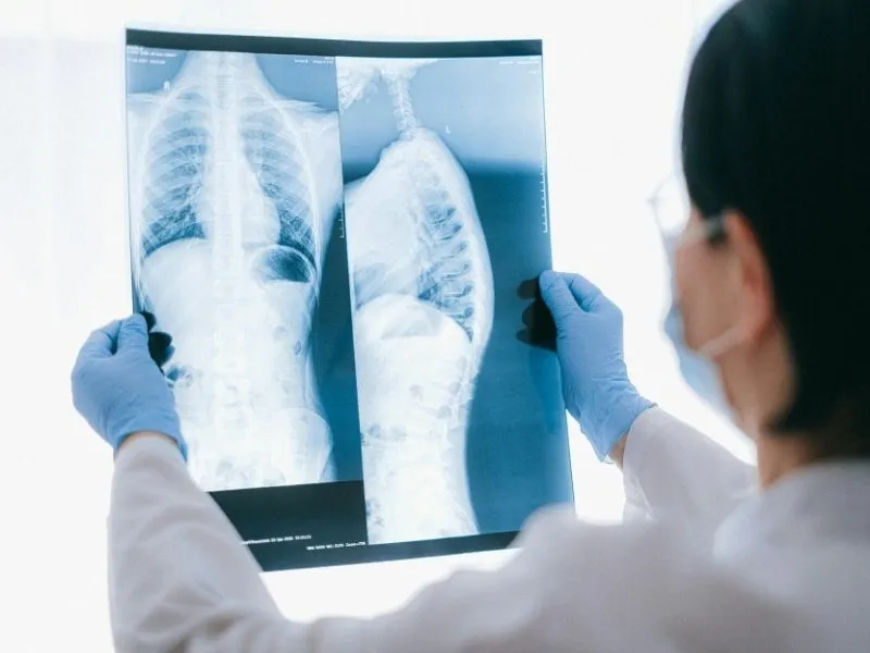 Fisioterapeuta avaliando um raio X de um paciente com Hipercifose