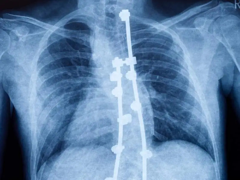 raio-x de uma coluna mostrando a cirurgia da coluna com Hipercifose.