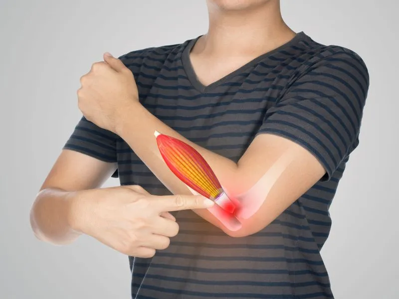 Tratamento da Epicondilite Lateral com Fisioterapia 2 Uma pessoa mostrando o local da ocorrência da Epicondilite Lateral.