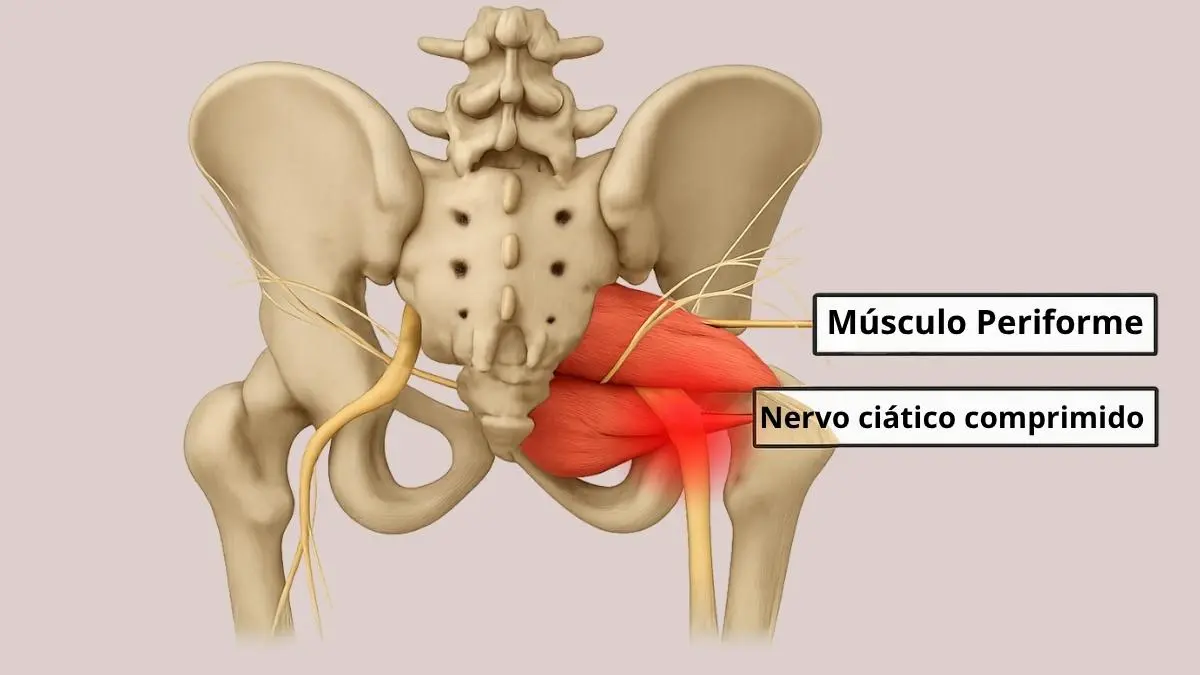 Síndrome do Piriforme: 9% Operam Errado 4 Síndrome do Piriforme: 9% Operam Errado