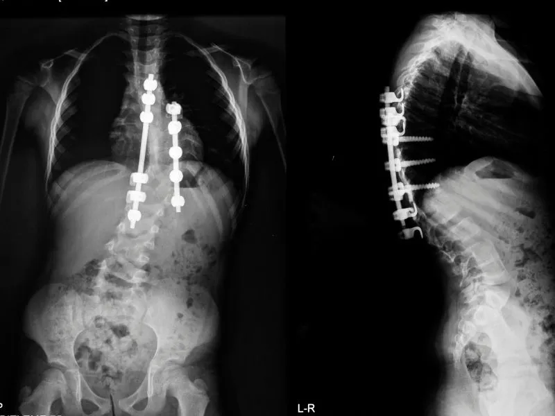 Escoliose idiopática: cirurgia ou tratamento conservador? 3 Raio x de uma coluna vertebral com escoliose idiopática operada.